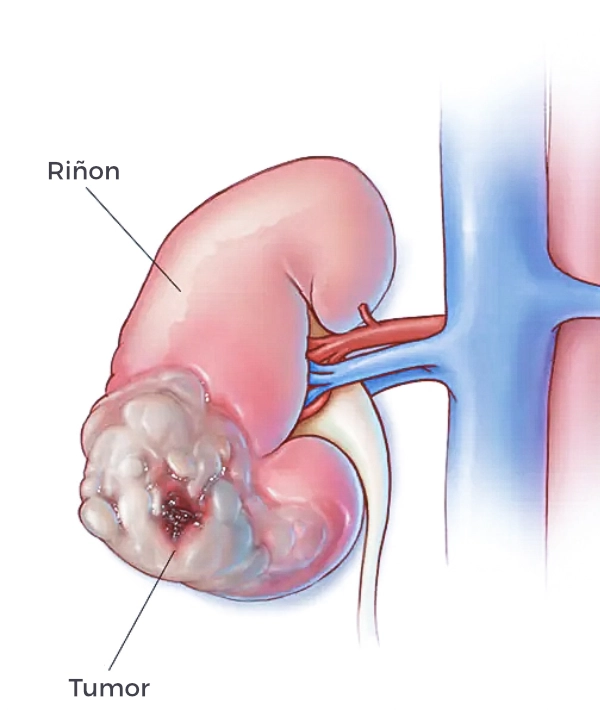 cáncer renal